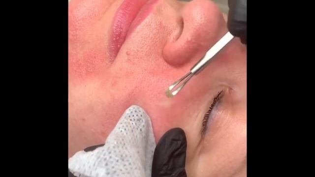 выдавливание прыщей   выдавливание чёрных точек