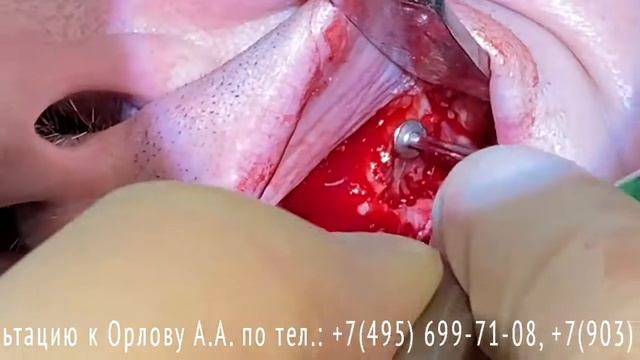 Ревизия дна гайморовой пазухи, резекция верхушек корней зубов 2.5; 2.7 Профессор Орлов А.А. смотреть онлайн