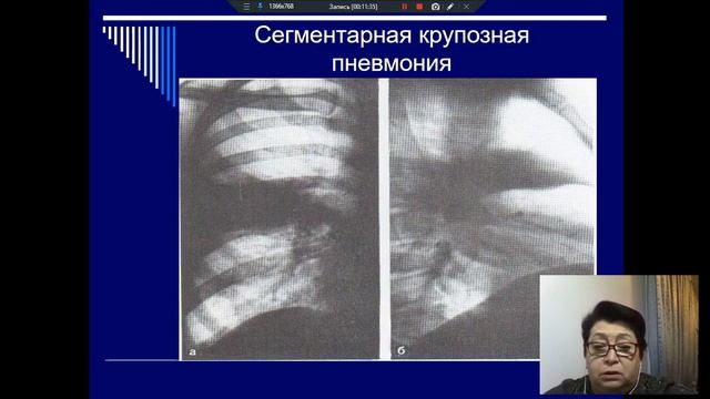 Пневмонии