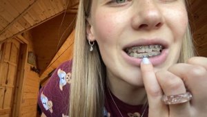 4 МЕСЯЦА С БРЕКЕТАМИ #брекеты #самолигирующиебрекеты #мояисториябрекетов Музыка: @LacoreDiamond