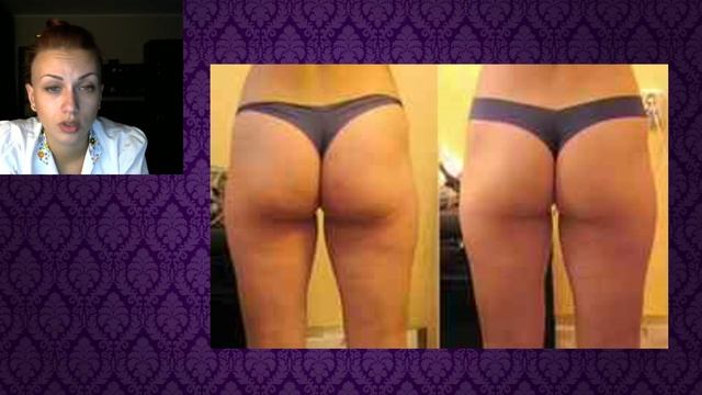 Антицеллюлитный массаж.Правда и вымысел.Результаты.Техника проведения.