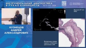 У клапанов сердца бывают аневризмы