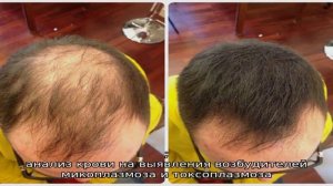 Очаговая алопеция у мужчин: симптомы, причины и лечение