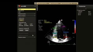Автоматическое определение фракции выброса и стрейн