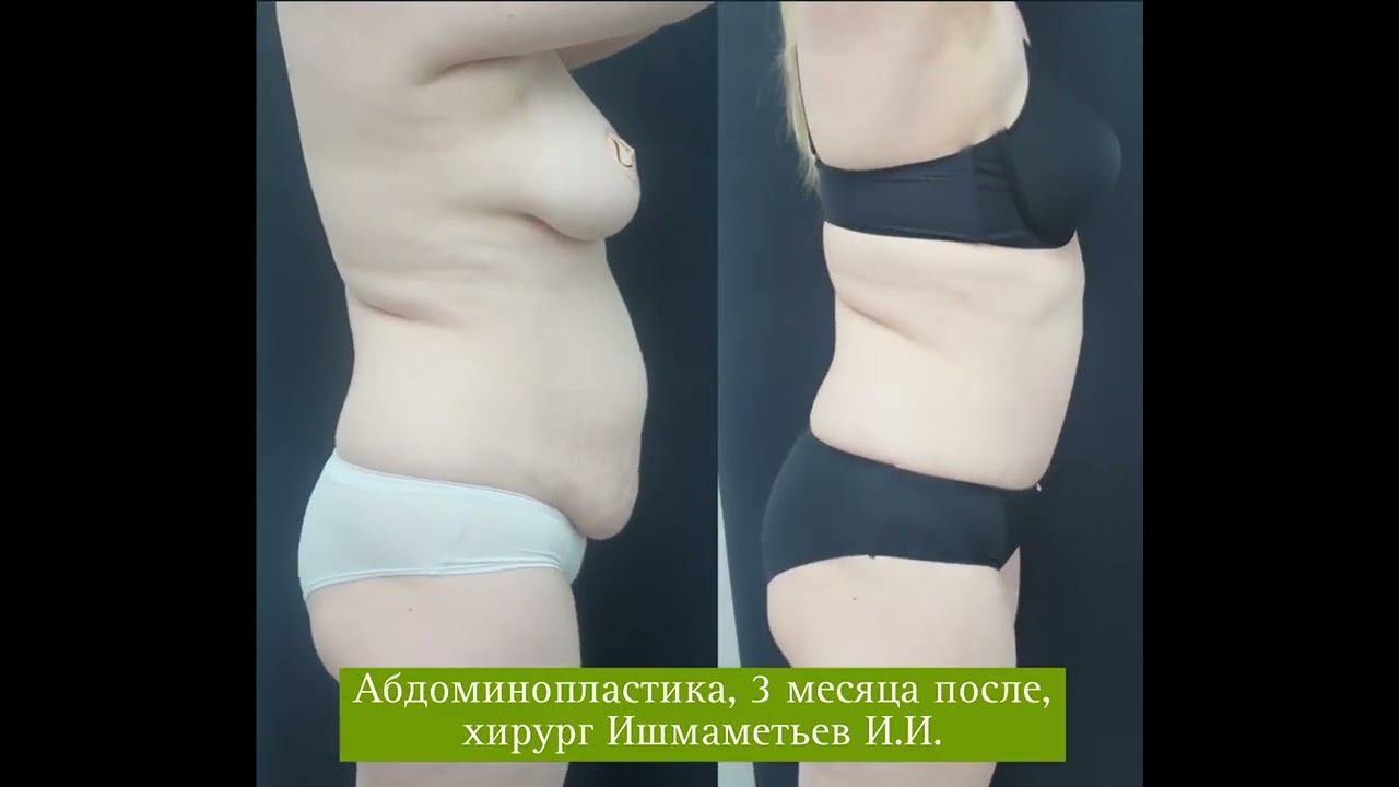 Абдоминопластика