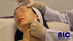 Процедура введения филлера Stylage XL с лидокаином. Скуловая область. Врач - Валерий Потий.