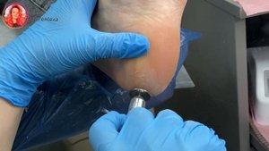 Потрескались пятки / Трещины на стопе / трещины на пятках / Педикюр