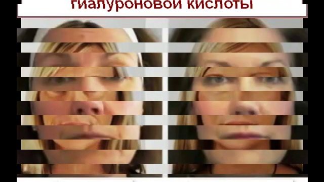 Гиалуроновая кислота