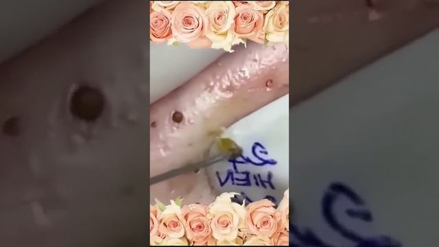 Blackheads Popping - 9