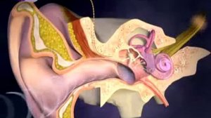 Кохлеарная имплантация.mp4