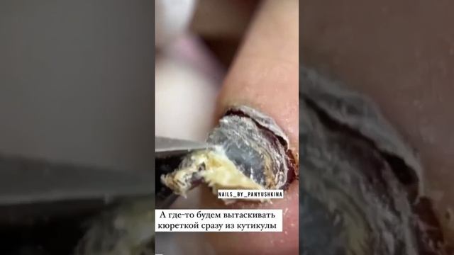 Зачистка травмированных ногтей #ногти #аппаратныйпедикюр #педикюр #подология #подолог #онихолизис