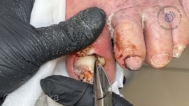 Черные ногти/ гной под ногтями/ как срезать толстые ногти смотреть онлайн