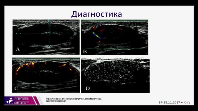 Фіброаденома молочної залози: сучасний менеджмент