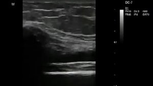 Тендиноз прямой мышцы бедра