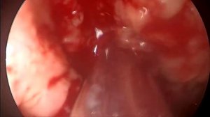 Аденотомия под эндоскопическим контролем с использованием шейвера