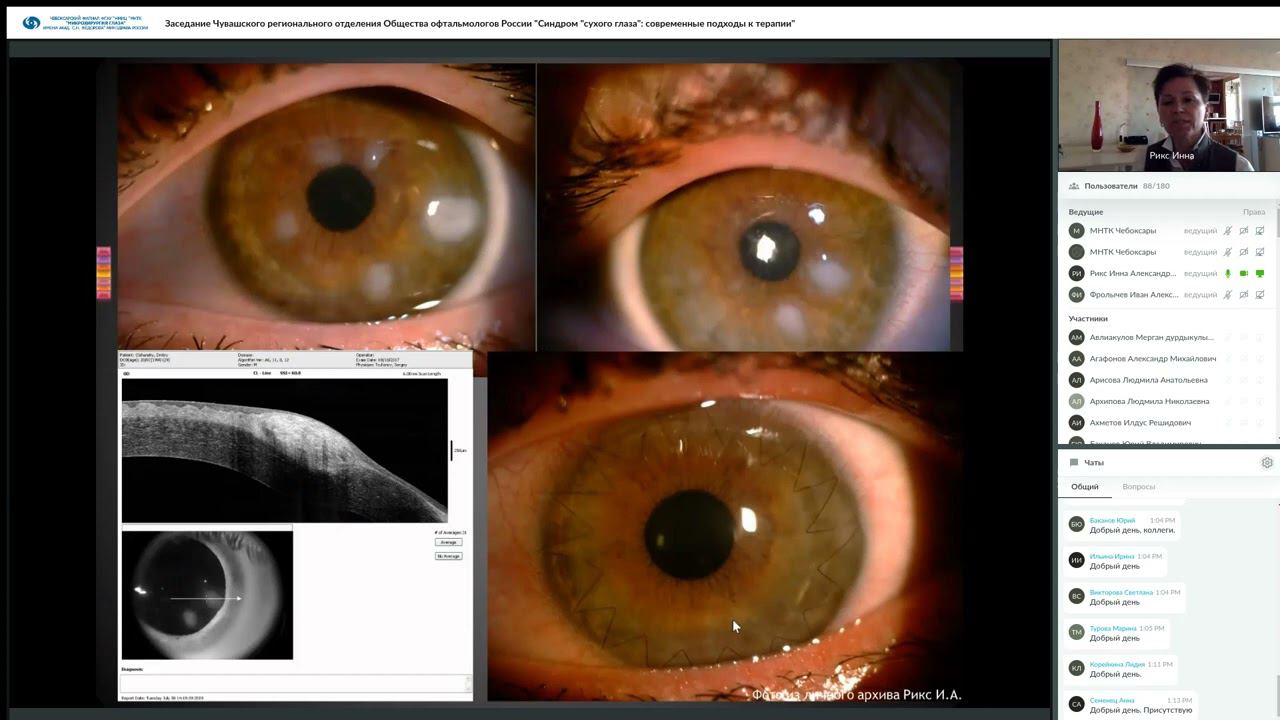 Заседание Чувашского РООР Синдром сухого глаза. Современные подходы к терапии 17.03.23 смотреть онлайн