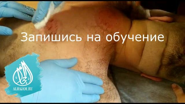 Ударно динамический массаж по Максимову и Хиджама смотреть онлайн