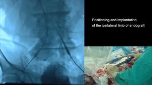 Эндопротезирование брюшной аорты (EVAR) "плохой"  шейкой, фиксация HeliFx и Chimney левой почки