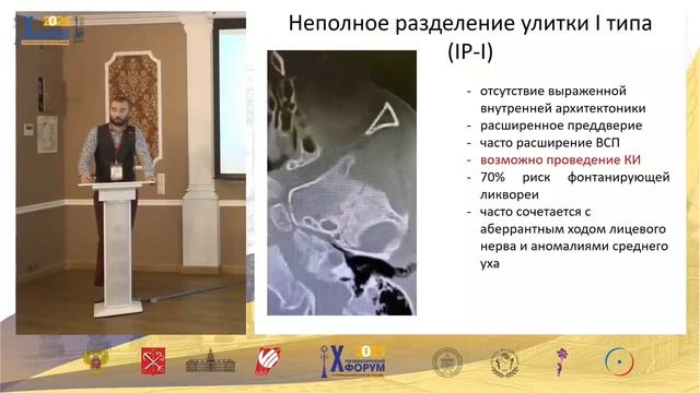 Кохлеарная имплантация