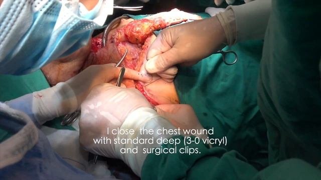 The Deltopectoral Flap For Closure. Of  A Pharygostoma's Rupture.