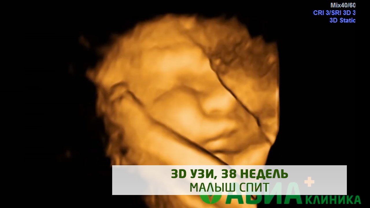 3D УЗИ, 38 недель. Малыш спит