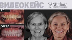 Тотальная имплантация и выравнивание на брекет-системе