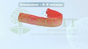 Базальная имплантация. ? Как проходит базальная имплантация при пародонтите?  ROOTT
