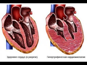 Спортивное сердце / Sports Heart
