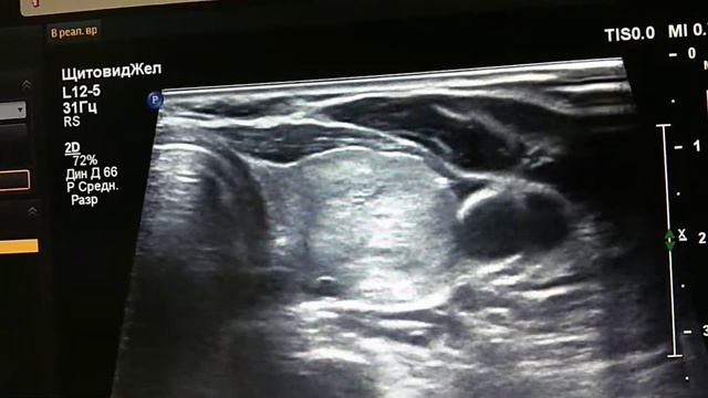 узлы щитовидной железы, thyroid nodes смотреть онлайн