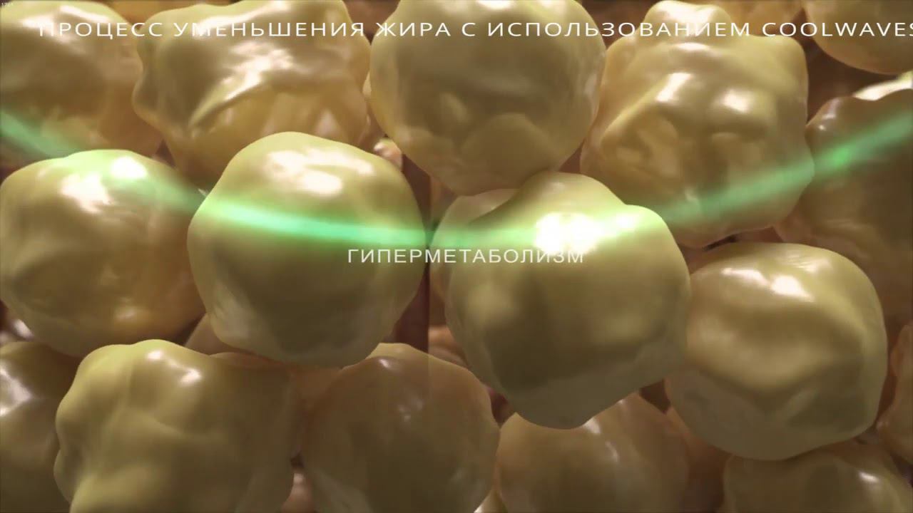 Новый методе коррекции фигуры в АРклиник - микроволновой липолиз