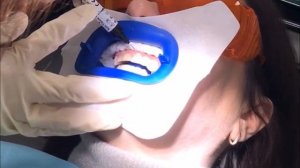 Отбеливание зубов Zoom 4 в Москве по выгодным ценам