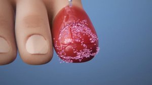 Ingrown toenail removal Treatment | Step by step