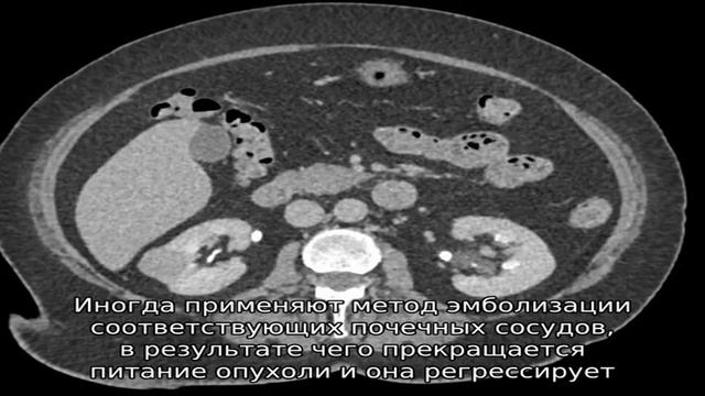 Аденома почки смотреть онлайн