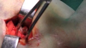 Интрамедуллярный остеосинтез плечевой кости Humerus shaft IMN