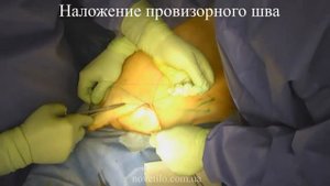 Липосакция фланков и миниабдоминопластика