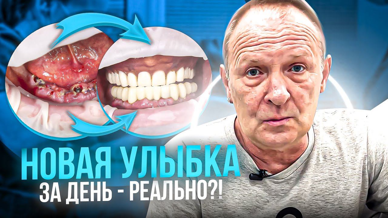 НОВАЯ УЛЫБКА с помощью системы ALL-on-4