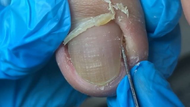 Easily trim ingrown nails and make your feet comfortable~【Crazy pedicure room】 смотреть онлайн