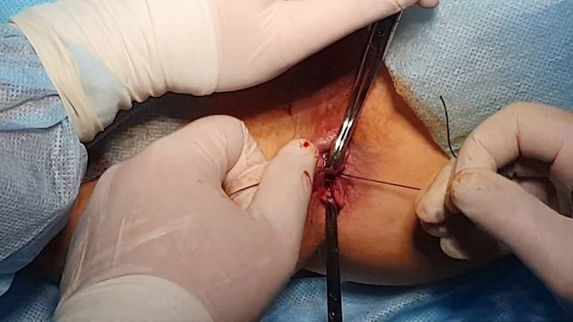 Иссечение заднего неполного внутреннего свища прямой кишки, иссечение полипа анального канала смотреть онлайн