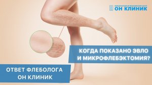 Когда показана ЭВЛО и микрофлебэктомия? Ответ флеболога ОН КЛИНИК