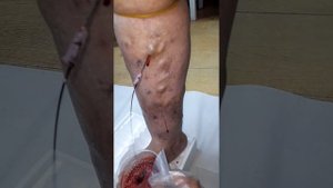 Венозное кровопускание При Варикозном расширении вен .0708105040