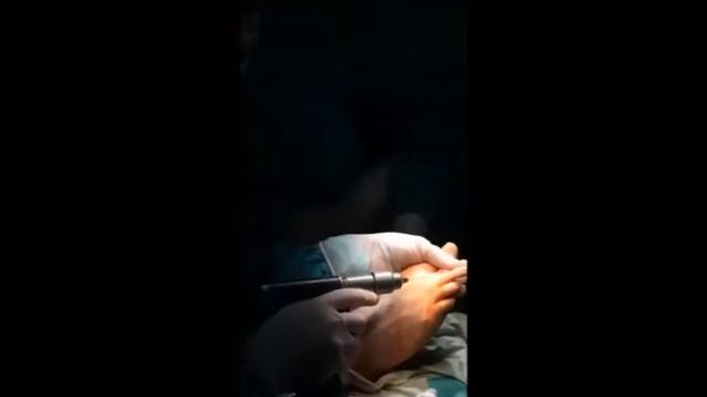 Hallux Valgus. Вальгусная деформация первого пальца стопы.