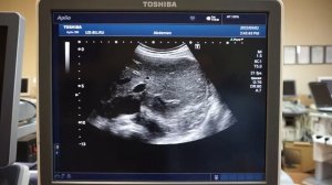 Toshiba Aplio 500 (2012 г.в.) обзор ультразвукового сканера