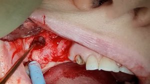 Открытый синуслифтинг в обл. 16. Н от 9.10.20г. lateral sinus lift