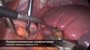 Лапароскопическая спленэктомия