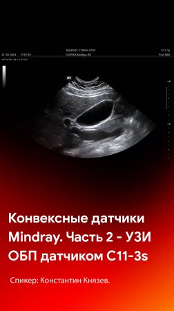 Конвексные датчики Mindray. Поджелудочная железа, желчный пузырь и воротная вена на C11-3s