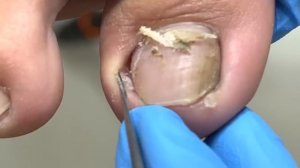 Black on both sides of the toenail, clean it carefully【Xue Yidao】