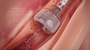 Тромбэктомия при инфаркте миокарда Capture MegaVac Mechanical Thrombectomy System