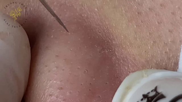 Acne Treament Under The Skin #068