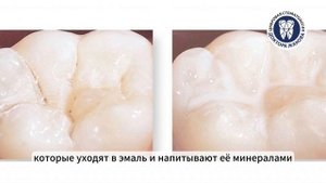Герметизация фиссур