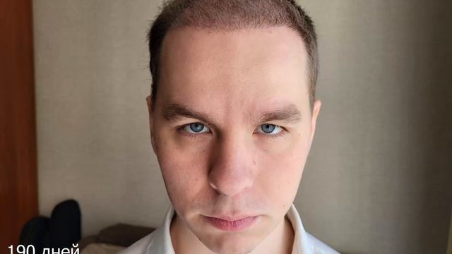 (НЕ)удачная пересадка волос. Или..?